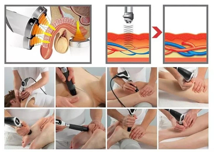 Shockwave Therapy