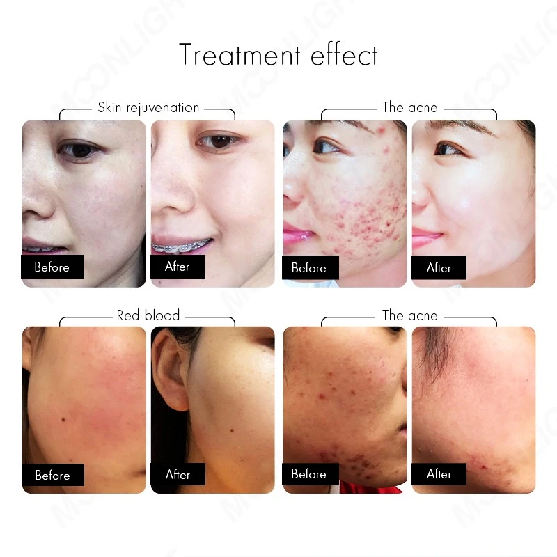 Advanced IPL SHR + Diode Laser Hair Removal System – Multi-Technology Platform For Modern Aesthetic Clinics factory
